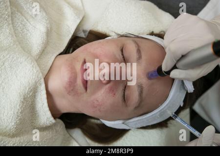 Mesotherapy. Woman having dermapen facial treatment. Micro needle cosmetic treatment at dermatologist. Stock Photo