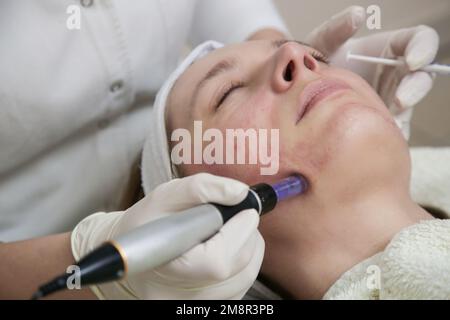 Mesotherapy. Woman having dermapen facial treatment. Micro needle cosmetic treatment at dermatologist. Stock Photo