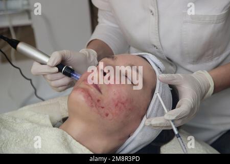 Mesotherapy. Woman having dermapen facial treatment. Micro needle cosmetic treatment at dermatologist. Stock Photo