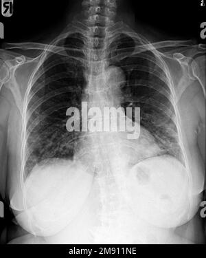 Film chest x-ray of normal woman chest . Stock Photo