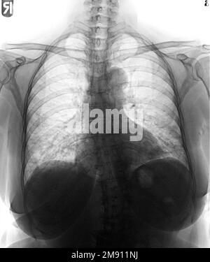 Film chest x-ray of normal woman chest . Stock Photo