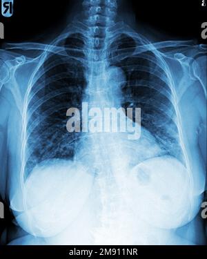 Film chest x-ray of normal woman chest . Stock Photo