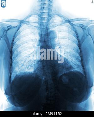 Film chest x-ray of normal woman chest . Stock Photo