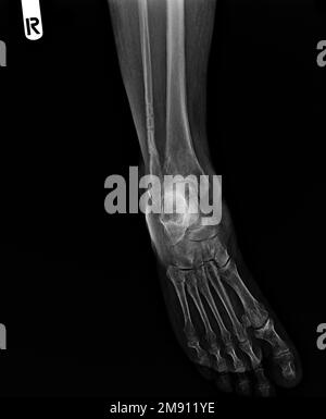 film x ray fracture of broken ankle Stock Photo