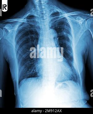 Film chest x-ray show interstitial infiltration both lung Stock Photo