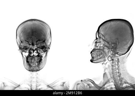 skull x ray isolated on white background Stock Photo