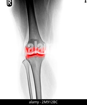 Osteoarthritis knee . film x-ray AP ( anterior - posterior ) Stock Photo