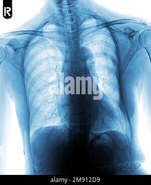 Film chest x-ray show interstitial infiltration both lung Stock Photo