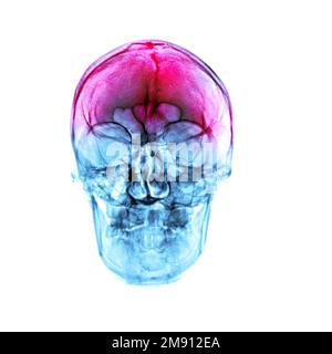 Headache of trauma. Film x-ray human skull . front view . Stock Photo