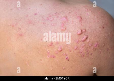 occipital acne in a teenage boy healed, scars from teenage acne on the shoulders, skin infections and allergies to the body of a man, healthcare and m Stock Photo