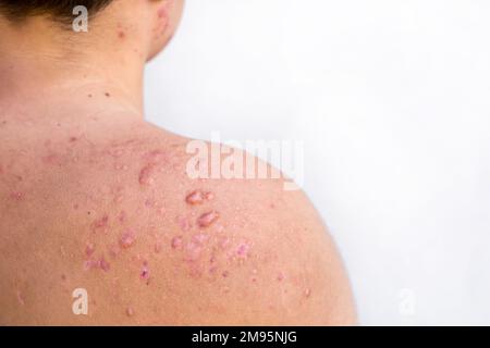 occipital acne in a teenage boy healed, scars from teenage acne on the shoulders, skin infections and allergies to the body of a man, healthcare and m Stock Photo