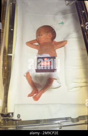 A baby girl weighing only two pounds lies on a sheet at Redhill Hospital, Surrey.  A matchbox has been placed on top to show how tiny she is. Stock Photo
