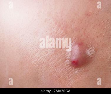 Bacterial skin infection. Big Acne Cyst Abscess or Ulcer Swollen area  within face skin tissue. Containing accumulation of pus and blood. Macro  shot of Stock Photo - Alamy