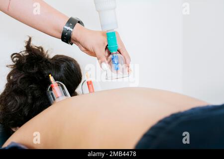 Physiotherapist placing cupping on lying patient, Close up of professional performing cupping treatment on patient, Modern Physiotherapy with cupping Stock Photo