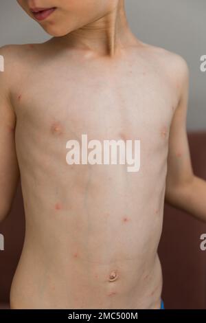 Young toddler with chickenpox. Sick child with chickenpox. Varicella virus or Chickenpox bubble rash on child. Portrait of little boy with pox. Stock Photo