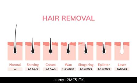 Hair laser removal treatment skin vector illustration bikini cosmetic light medical surgery woman armpit laser hair removal. Stock Vector