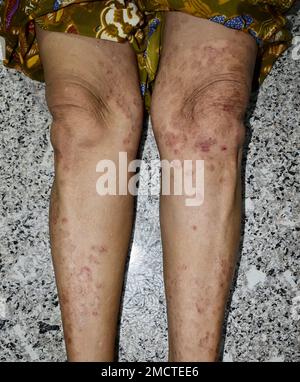 Fungal infection called tinea corporis in leg of Asian woman. Widespread ringworm over lower limb. Stock Photo