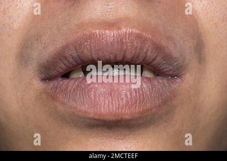 Dry, cracked and dehydrated lips of Asian young man. Stock Photo