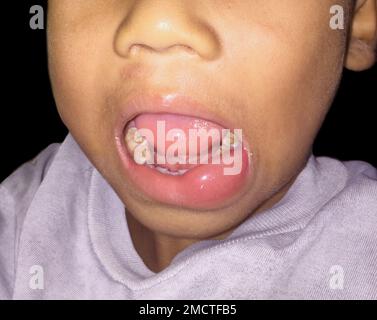 Angioedema at the lower lip of Asian male child. Caused by drug, seafood or chemical allergy and insect bite. Stock Photo