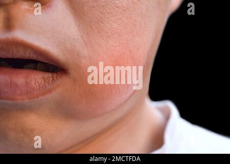 Painful And Large Cheek Or Jaw Swelling Or Submental And Submandibular ...