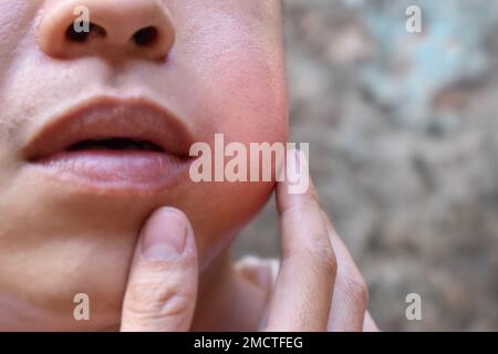 Swelling at the cheek of Asian young man. Inflammation of parotid gland called parotitis. Mumps. Stock Photo