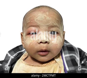 Angioedema at the right eyelid of Southeast Asian child. Caused by drug, seafood or chemical allergy and insect bite.
