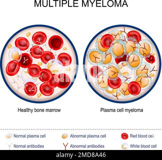 Multiple myeloma. Close-up of Healthy bone marrow and Plasma cell myeloma. Red and White blood cells, normal and abnormal antibodies. cancer of plasma Stock Vector