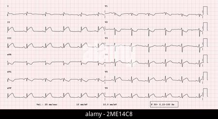 ECG example of 12-lead rhythm, acute myocardial infarction, real exam Stock Photo