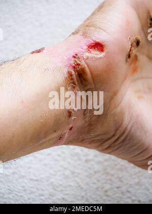 electric shock entry and exit wounds and burns in 50s adult caucasian man hand wrist healing and skin peeling after medical treatment. Stock Photo