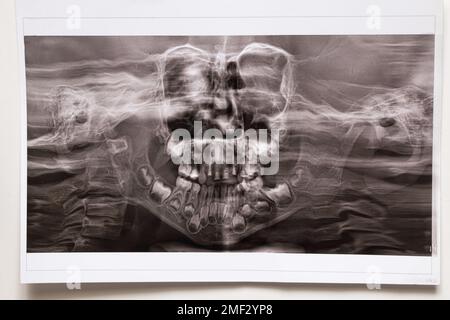 A panoramic X-ray shows several embedded and impacted teeth on both the upper and lower jaw of children's teeth Stock Photo