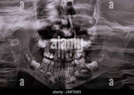 A panoramic X-ray shows several embedded and impacted teeth on both the upper and lower jaw of children's teeth Stock Photo