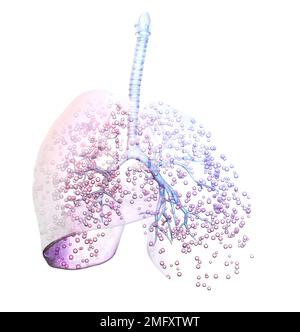 3D Illustration showing lung cancer Stock Photo - Alamy