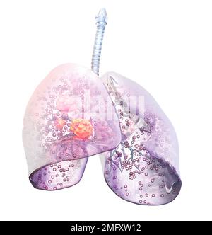 3D Illustration showing lung cancer Stock Photo - Alamy