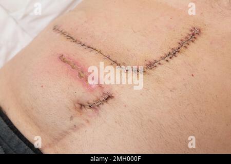 Close up of Surgical Staples used to Close Incision After Abdominal ...