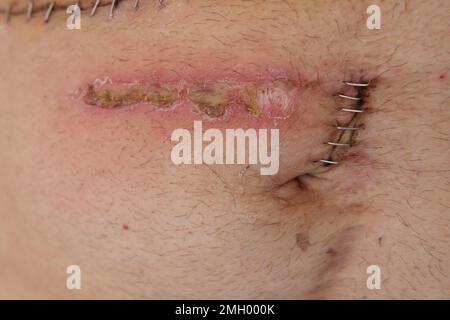 Close up of Surgical Staples used to Close Incision After Abdominal ...