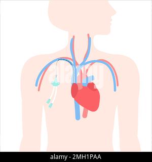 Tunneled central line venous catheter medical diagram Stock Vector