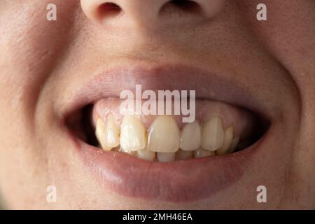 crooked yellow teeth of a young girl close-up, open growing with bad teeth for example, teeth and mouth, caries Stock Photo