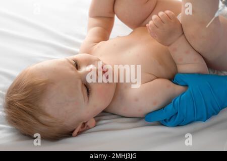 Doctor Checking Skin of Sick Girl. Kid with Red Rash being Examined at the Physician. Allergic Rash, Chicken pox, Monkeypox Symptoms on the Body of Ch Stock Photo