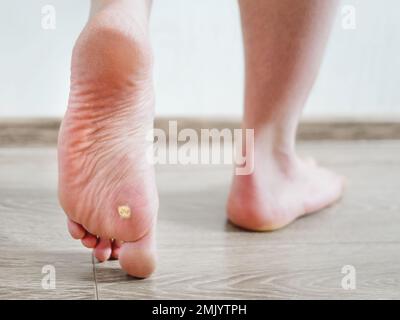Close up photo of plantar wart on man's foot. Verruca plantaris on the heel. Stock Photo