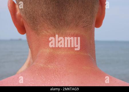 The man received sunburn on the seashore. The skin peels off. Protection of the skin from the sun. Stock Photo