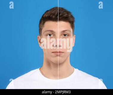 Teenager before and after acne treatment on blue background Stock Photo