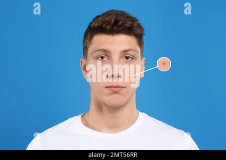 Teenage boy with acne problem on blue background Stock Photo