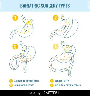 Bariatric surgery weight loss procedure types infographics Stock Vector
