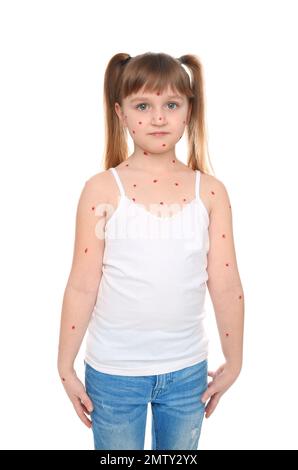 Little girl with chickenpox on white background Stock Photo