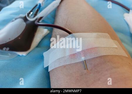 young blood donor with large needle stuck in forearm during donation at hospital Stock Photo