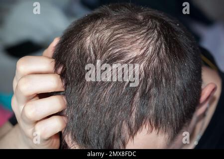 Dandruff in a man and hair loss. Male head with short hair and bald head. Seborrhea is a disease of the nervous system Stock Photo