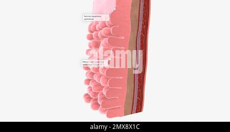 Adenocarcinoma of the esophagus results from abnormal cell mutations ...