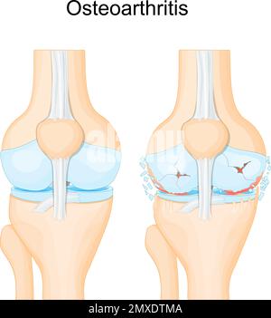 Knee osteoarthritis. degenerative joint disease. Cartilage becomes worn. Vector poster Stock Vector