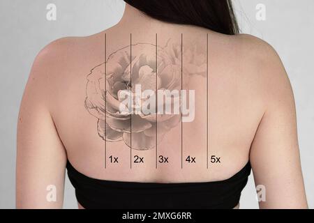 Laser Tattoo Removal On Woman's Back Against White Background Stock Photo