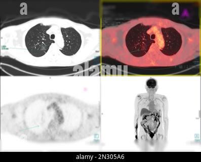 Positron emission tomography (PET) CT scan uses a radioactive drug (tracer) to show both normal and abnormal metabolic activity of Whole  human body Stock Photo